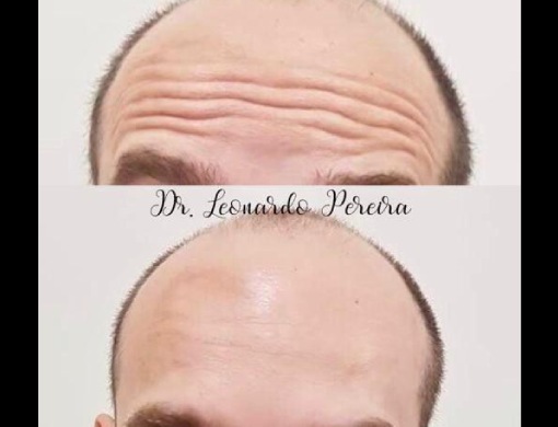 Botox e preenchimento facial - Leonardo Odontologia