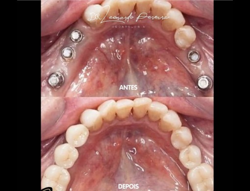 Resultado - Implantes dentários | Leonardo Odontologia