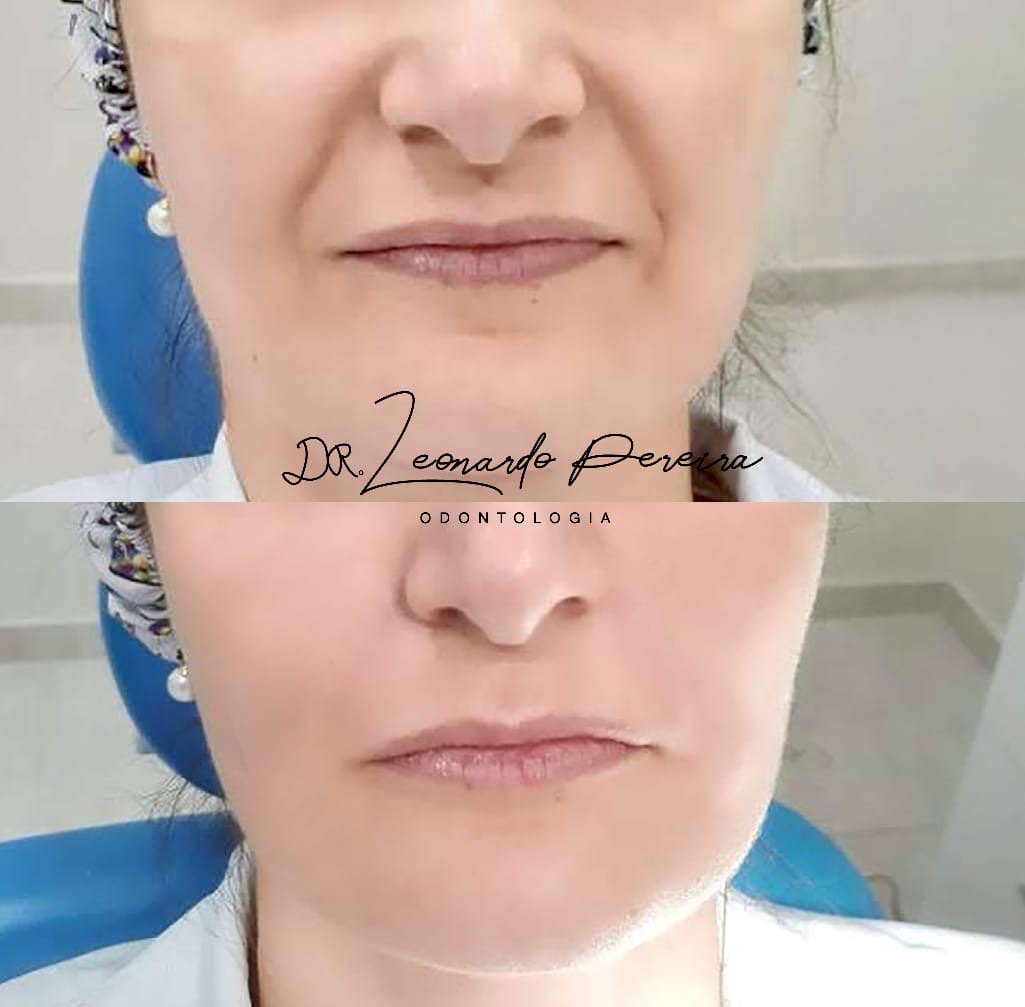  Clínica especializada - Botox e preenchimento facial | Leonardo Odontologia